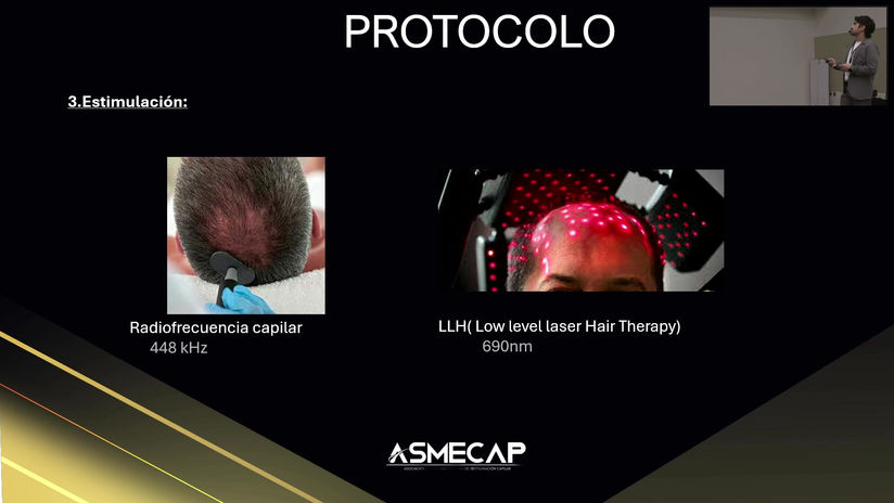 Protocolo Pre y Post Transplante Capilar. -Por Dr. Sebastian Londoño